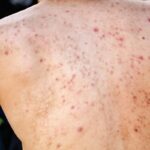 chico-con-foliculitis-espalda