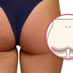 util-e-interesante-porque-tienes-manchas-oscuras-gluteos-n465645-580x348-1013456